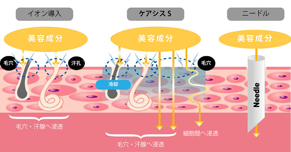 エレクトロポレーション（ケアシスS）